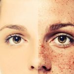 How to remove freckles naturally