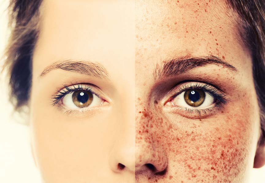 How to remove freckles - Get rid of freckles naturally