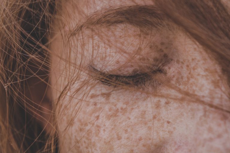 Unleash Your Flawless Skin in Just 2 Weeks: The Ultimate Guide to Banishing Freckles!